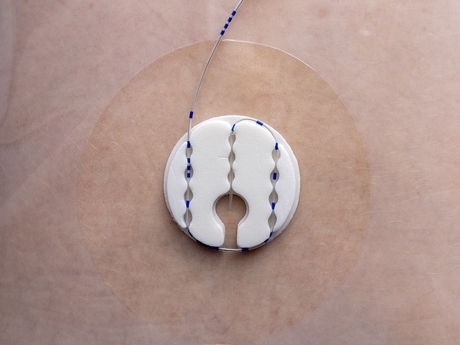 A close-up image of the Clik-Fix Catheter Securement Device on a patient's back.