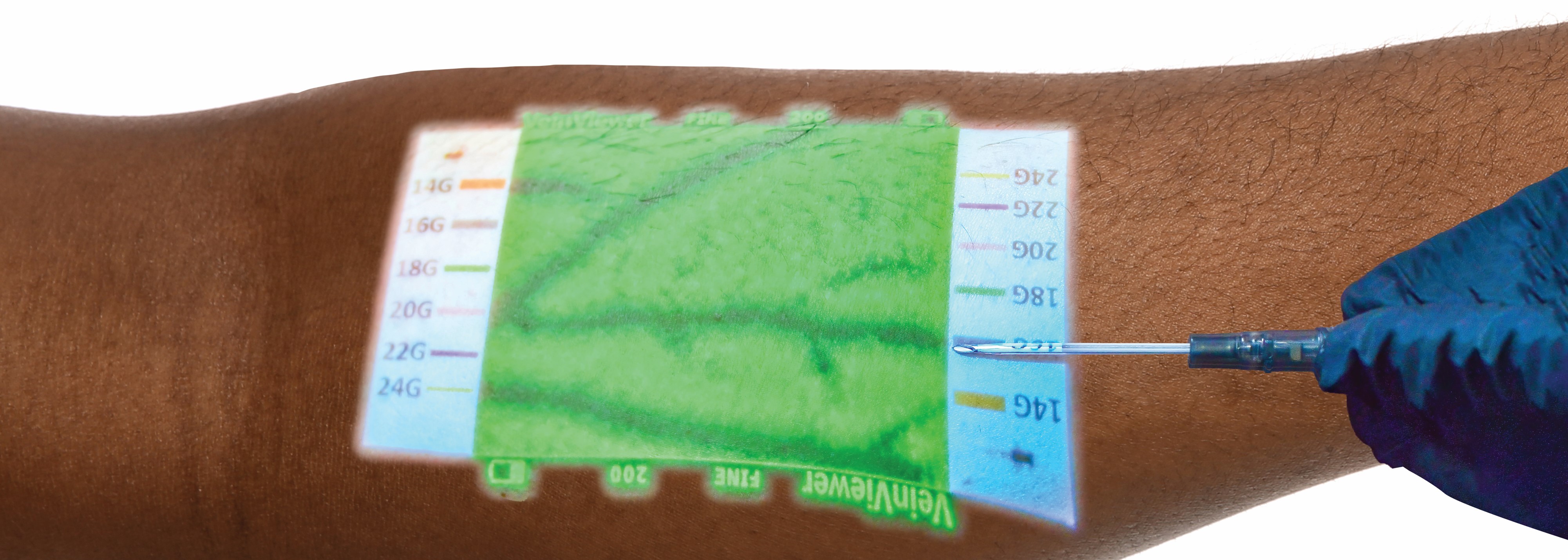 Gloved hand is inserting an IV, using the Veinviewer to see the patient's veins. 