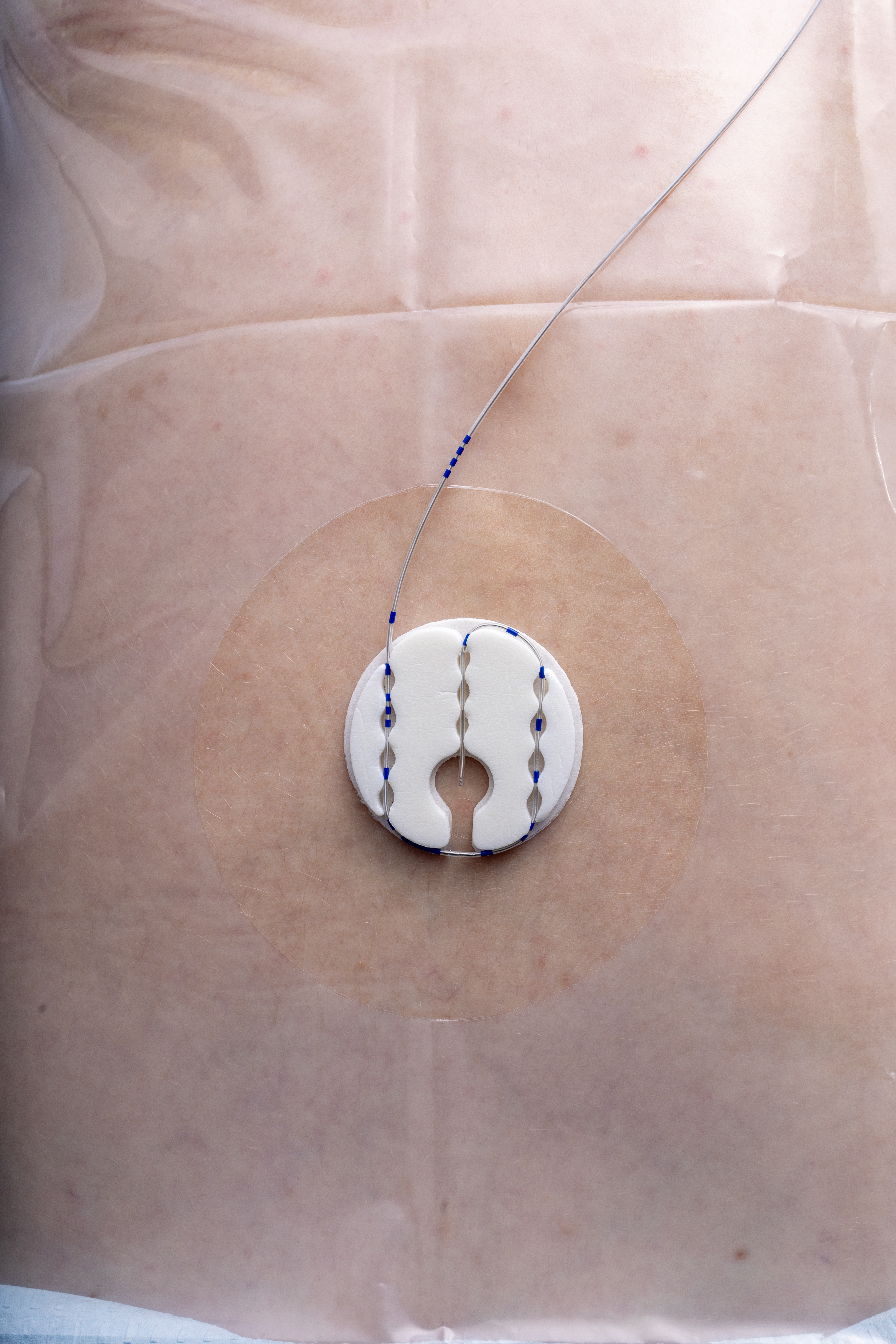 Click-FIX Epidural/PNB Catheter Securement Device on patient. 